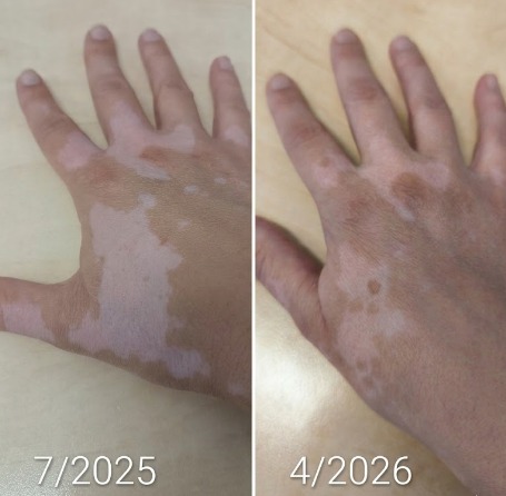 Vitistop gel before after