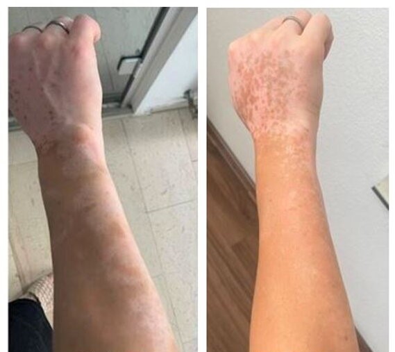 Vitiligo on the hand before and after UVB phototherapy