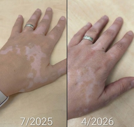 vitiligo on hands before after