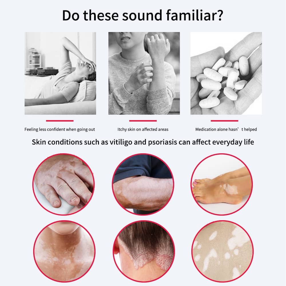 Indications for NB-UVB therapy