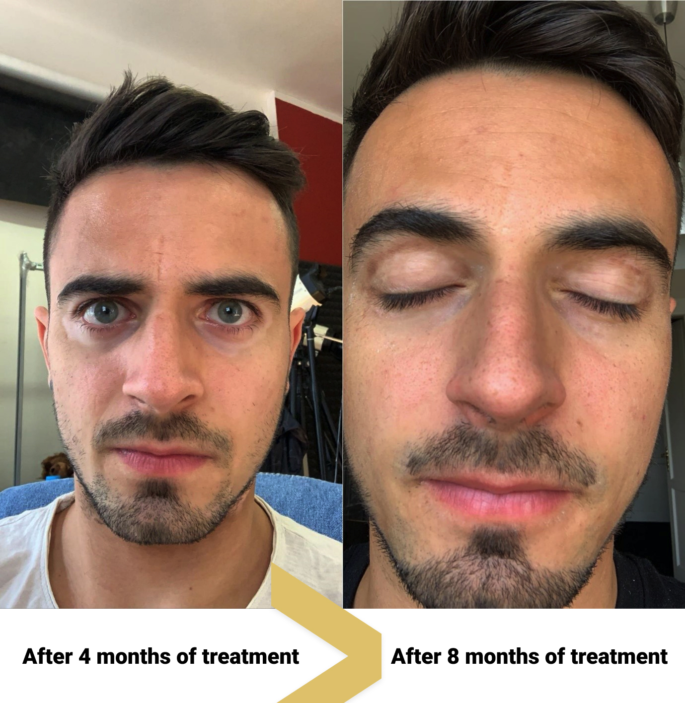 Vitiligo around eyes cured