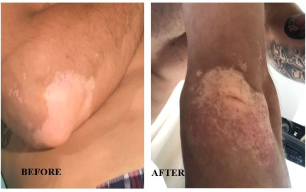 Elbow vitiligo improvement