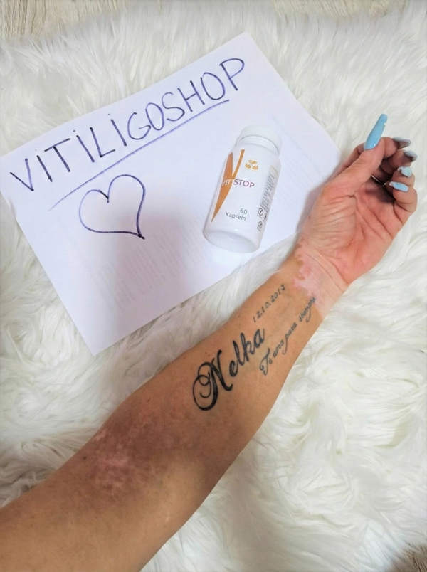 Helen Vitiligo before after photos with Vitistop tablets