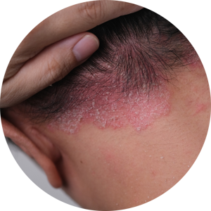 Psoriasis Treatment at Home