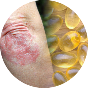 Psoriasis Treatment at Home