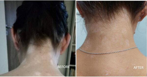 Vitiligo on the back of the neck