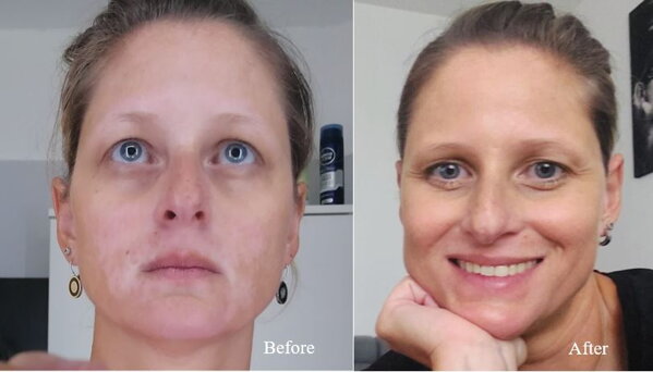 Vitiligo on the face before and after