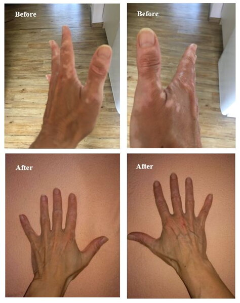 Active or stable vitiligo? How to tell it is spreading, and what that changes in treatment