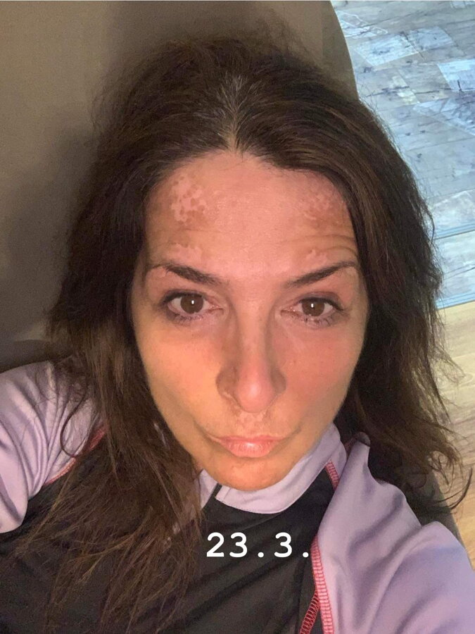 Facial vitiligo repigmenting during treatment – Andrea, VitiligoShop customer