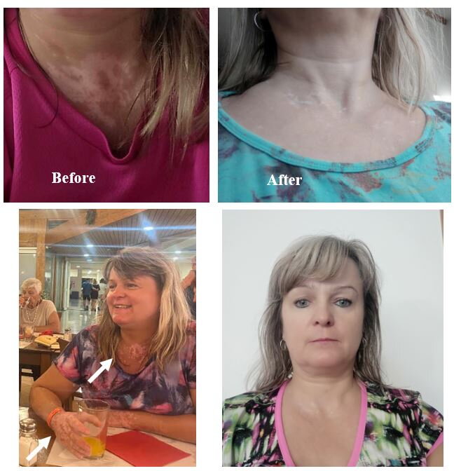 Vitiligo on the neck and upper chest, photos four months apart – Jane, VitiligoShop customer