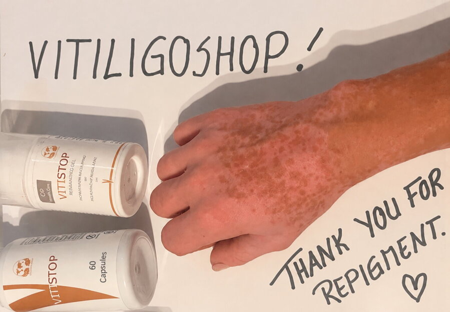Vitiligo on hand and fingers repigmenting – Julia, VitiligoShop customer