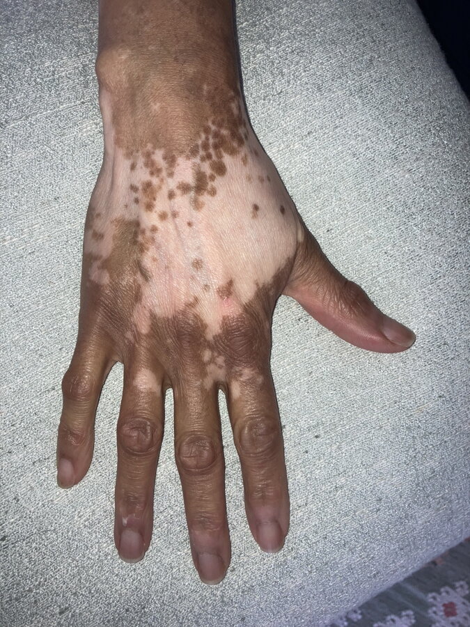 Repigmenting dots on the back of the hand – Norma, VitiligoShop customer
