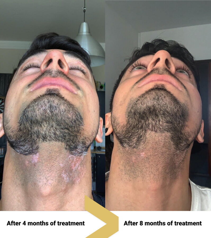 Vitiligo on the neck and under the jaw before and after treatment – Peter, VitiligoShop customer